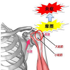上腕二頭筋長頭腱炎｜山梨県甲府市のいのうえ整骨院